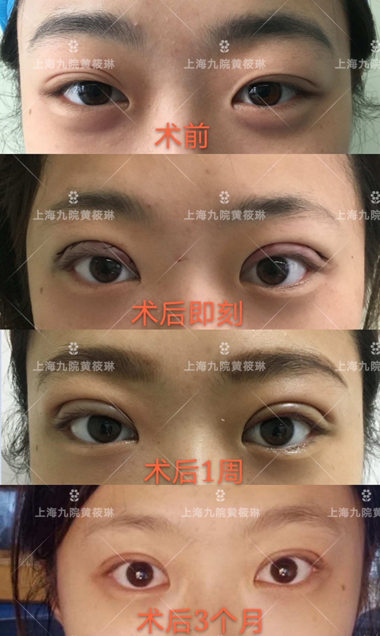 双眼皮消肿以后还是变宽,双眼皮吃什么药消肿比较快