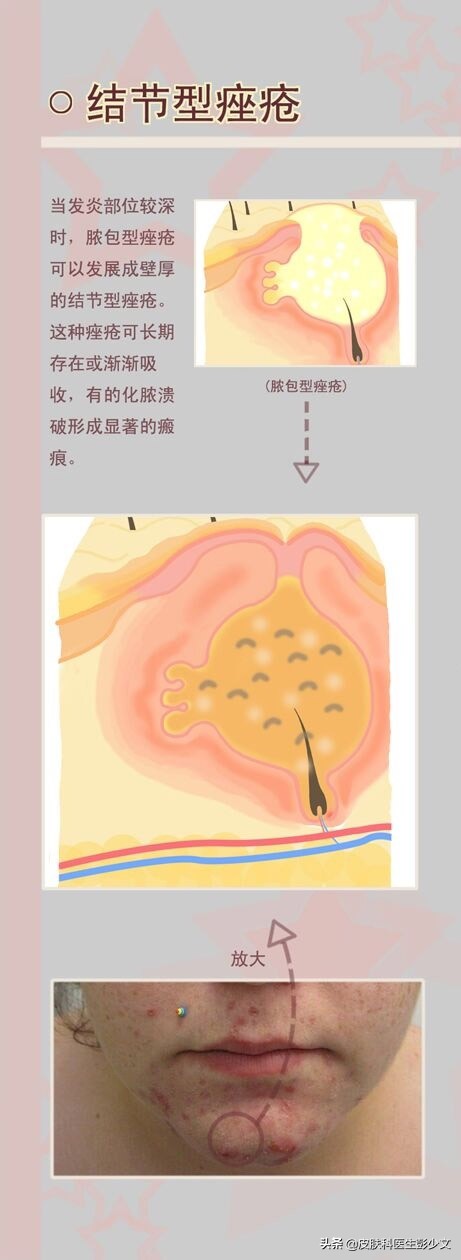 连续十年不停的长痘疮是怎么回事,身上长痘疮怎么治疗