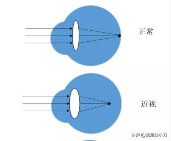 近视不老花，老花不近视？「内含抵消算法」