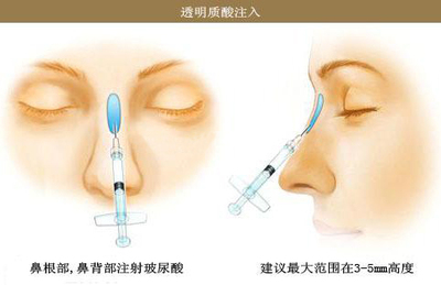 什么样的鼻子是好看的,女人什么样鼻子漂亮