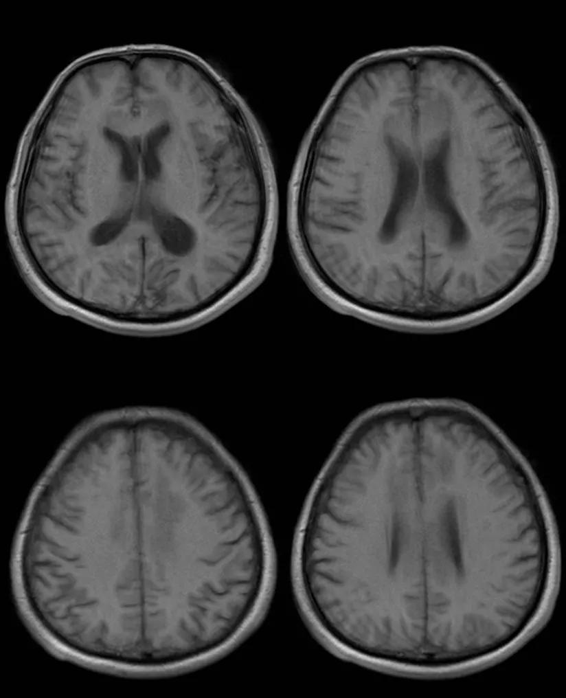 胼胝体有什么症状,胼胝体形态较小可以治疗吗