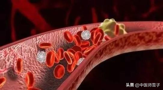 针灸拔罐祛富贵包的最快方法,富贵包针灸拔罐一次多少钱