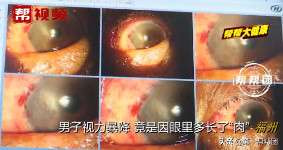 常在海边的注意了！男子视力严重下降，一查竟是眼中长了“肉”