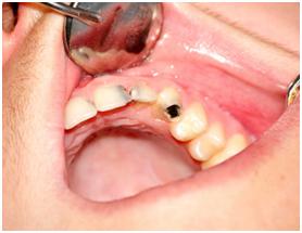 牙疼是因为蛀牙么,你有蛀牙和牙疼的困扰吗