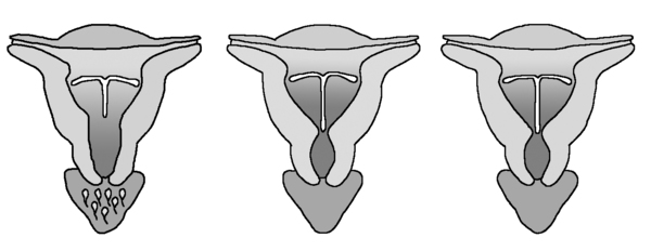 上环后肚子疼出血怎么回事,上环后腹痛出血怎么回事