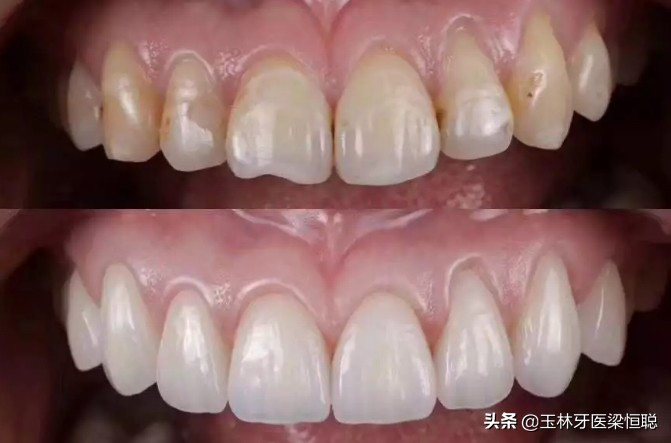 烤瓷牙和牙龈处变黑怎么处理,烤瓷牙牙龈发黑需要重新做烤瓷吗