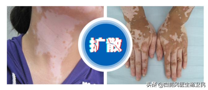 哪些误区阻挡你的白斑消除,白斑的真正可怕之处