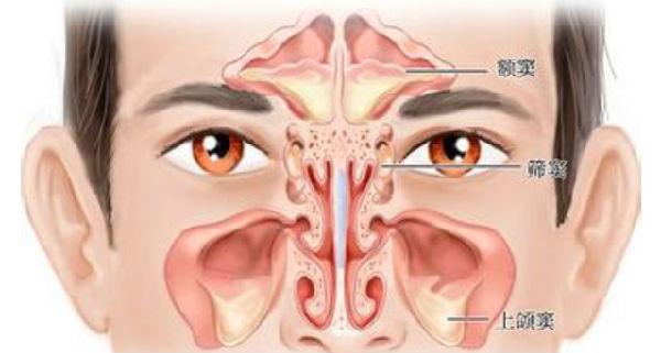 患上鼻窦炎有什么症状,婴幼儿患上了鼻窦炎