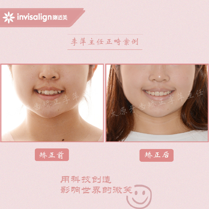 太原牙齿隐形矫正,太原牙齿正畸贵吗
