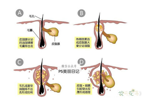 怎样能去掉黑头小妙招,怎样能去掉黑头和痘痘