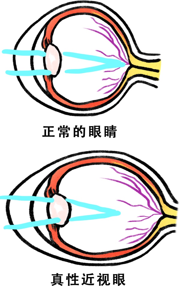 眺望远处对治疗近视有用吗,防控近视20分钟远眺