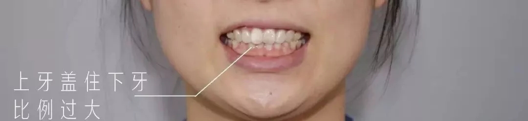 深覆盖vs深覆合,深覆盖和深覆合哪个难度大