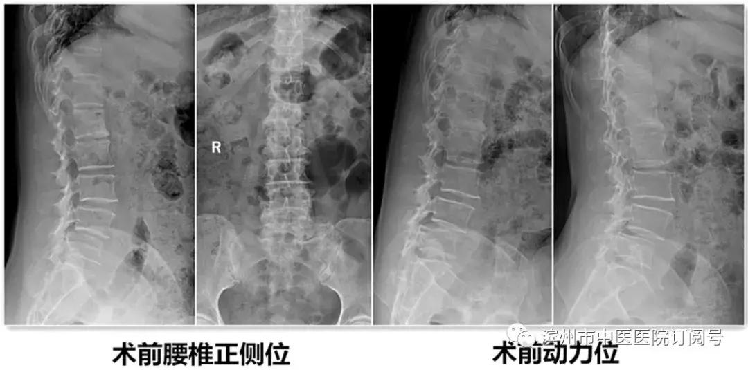 椎间盘突出保守治疗,椎间盘治疗视频大全
