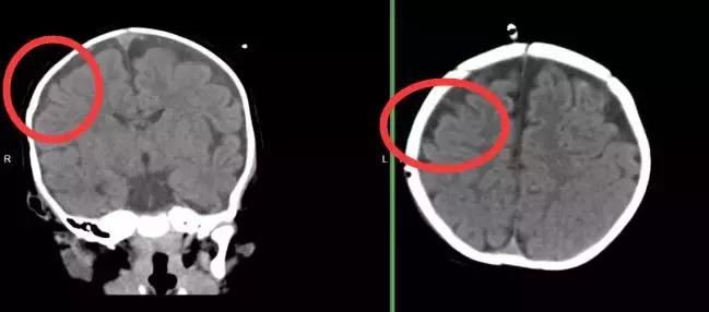 小孩颅脑损伤患者应如何处理,颅脑疾病的预防