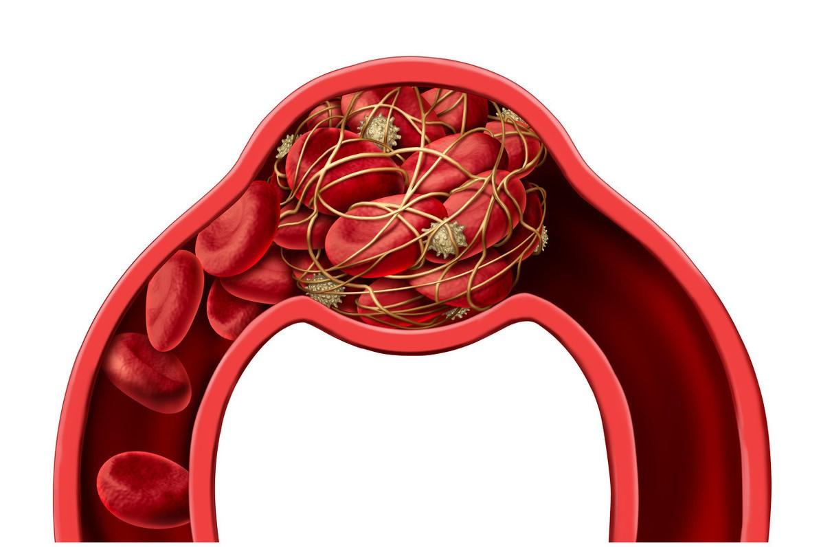 阿司匹林和氯吡格雷抗血小板机制,抗血小板阿司匹林氯吡格雷用量