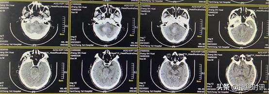 高血压小脑出血治愈率多大,高血压导致小脑出血