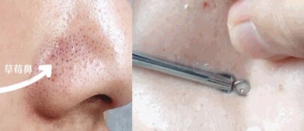 痘痘挤出的白米粒,痘痘挤出白点和血算干净了吗