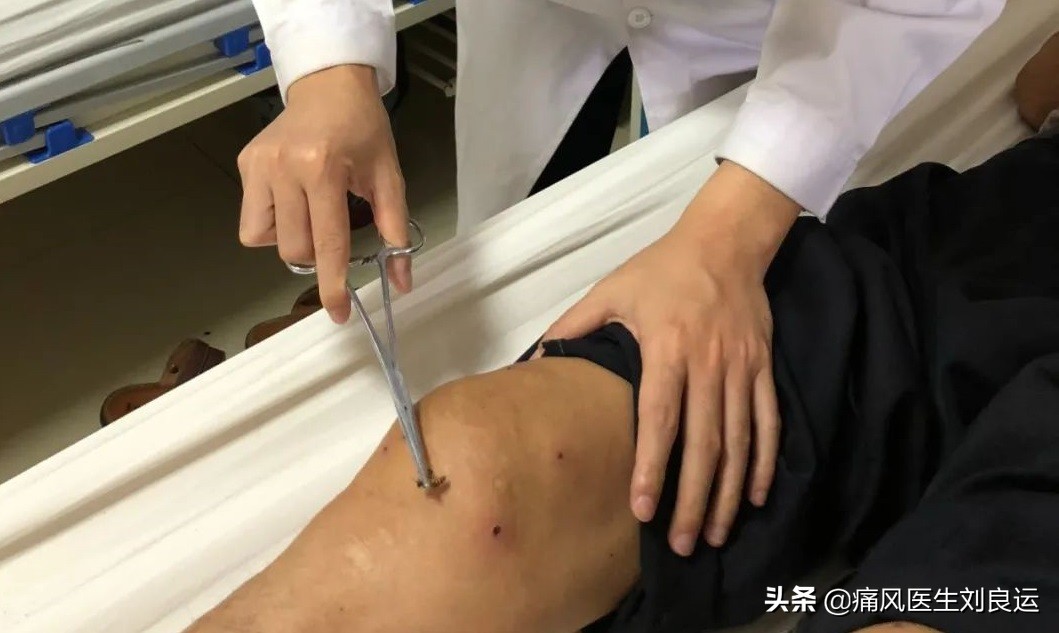 蜂针疗法可以治疗痛风吗,蜂疗灸可以治疗痛风吗