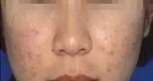 如何祛除痘印最有效的几招,教你几种有效去除痘印的方法