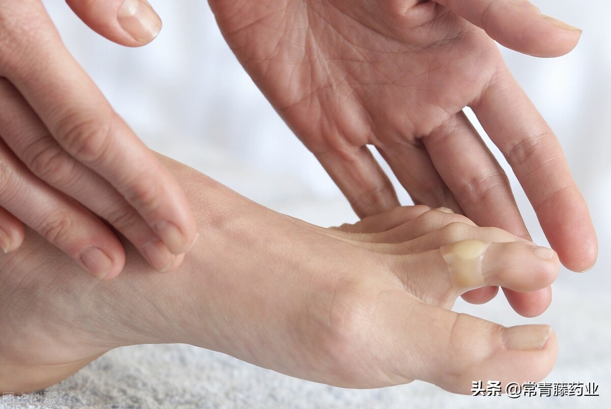 脸上会不会得脚气,脸上有脚气的人