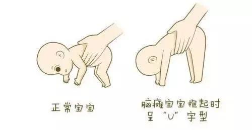 儿童骨科医生邱俏峰治疗脑瘫,小孩特别聪明怎么还被诊断自闭症