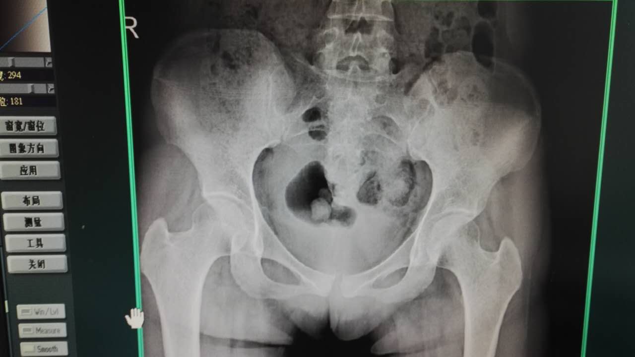 女性胯骨变宽是什么原因,胯大做骨盆修复胯会变小吗