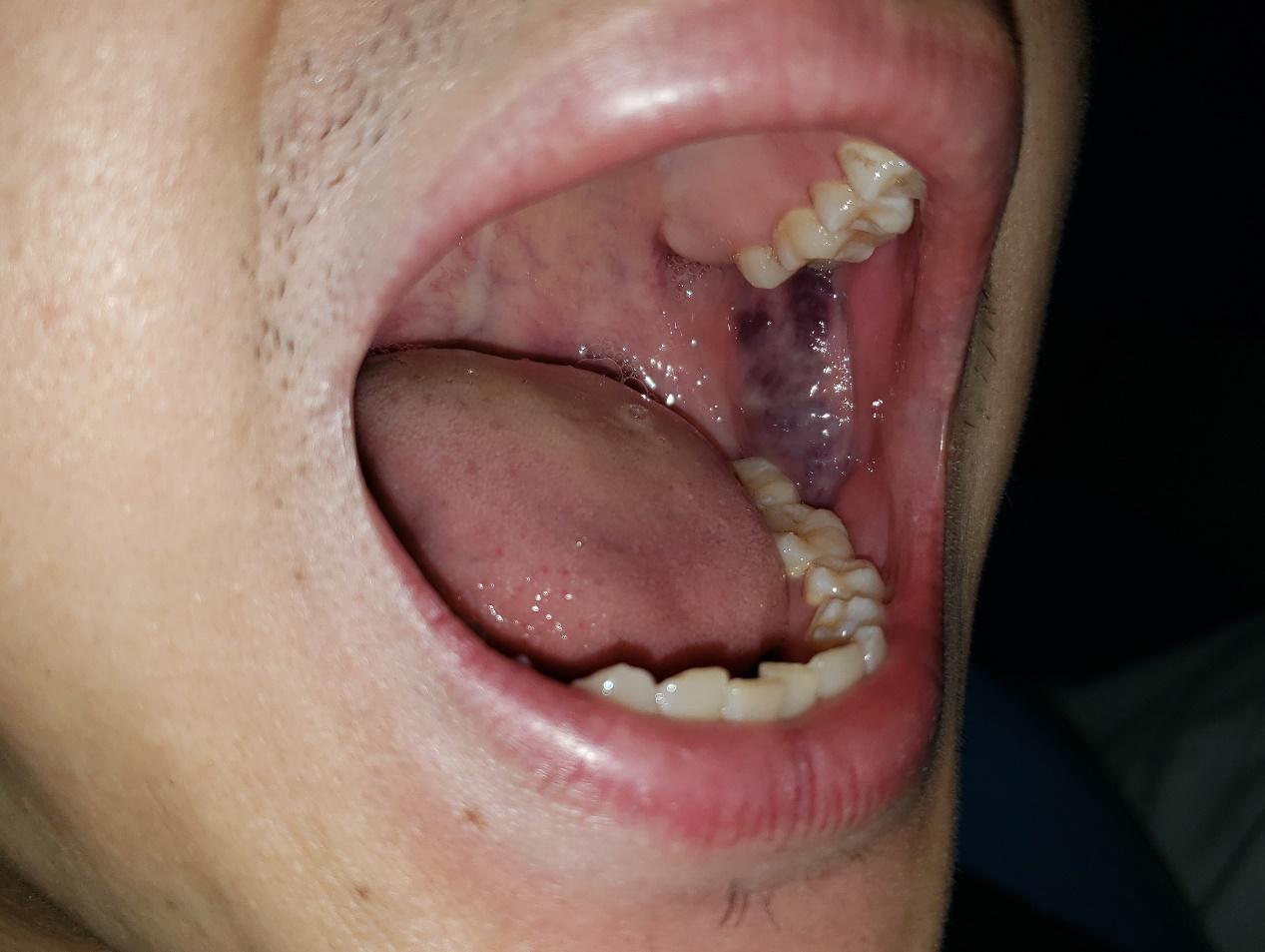 血管瘤与脉管畸形区别,血管瘤和脉管畸形有什么区别