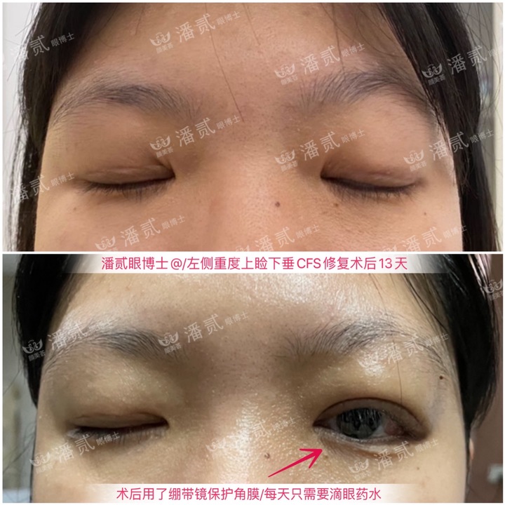 上睑下垂手术是不是永远闭不上眼,做了上睑下垂手术后怎么护理眼睛
