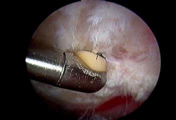 肩袖损伤要怎么处理,肩袖损伤专用膏药
