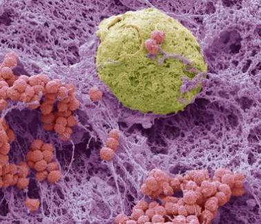 深度解读肺炎黏液|对于新冠肺炎的治疗的一些参考意见