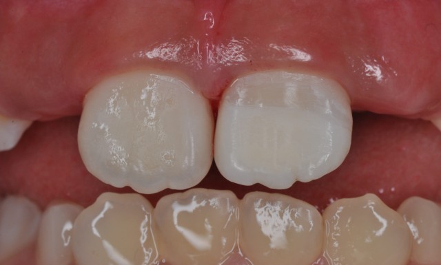 牙拔掉后扔掉还是留着,牙折断还能接回去吗