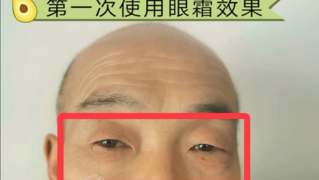 眼袋救星来了,医生推荐眼袋救星