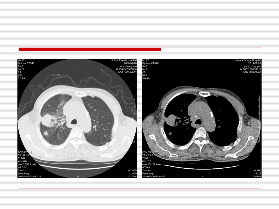 像炎症的肺癌能治好吗,医生说可能是肺癌也可能是炎症