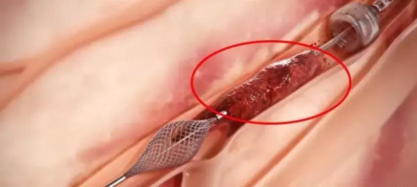 患者血栓手术实操全过程,解决血栓的最新技术