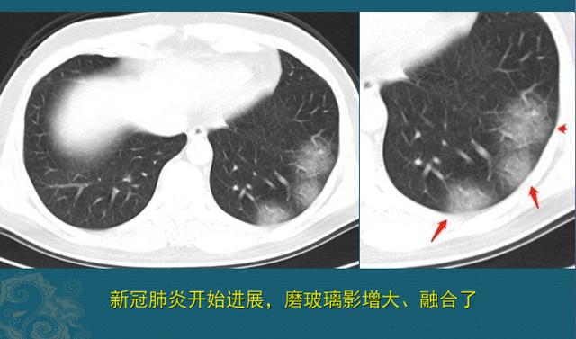 17岁肾炎，30岁尿毒症咳血，医生说有些病要尽早去大医院，能救命