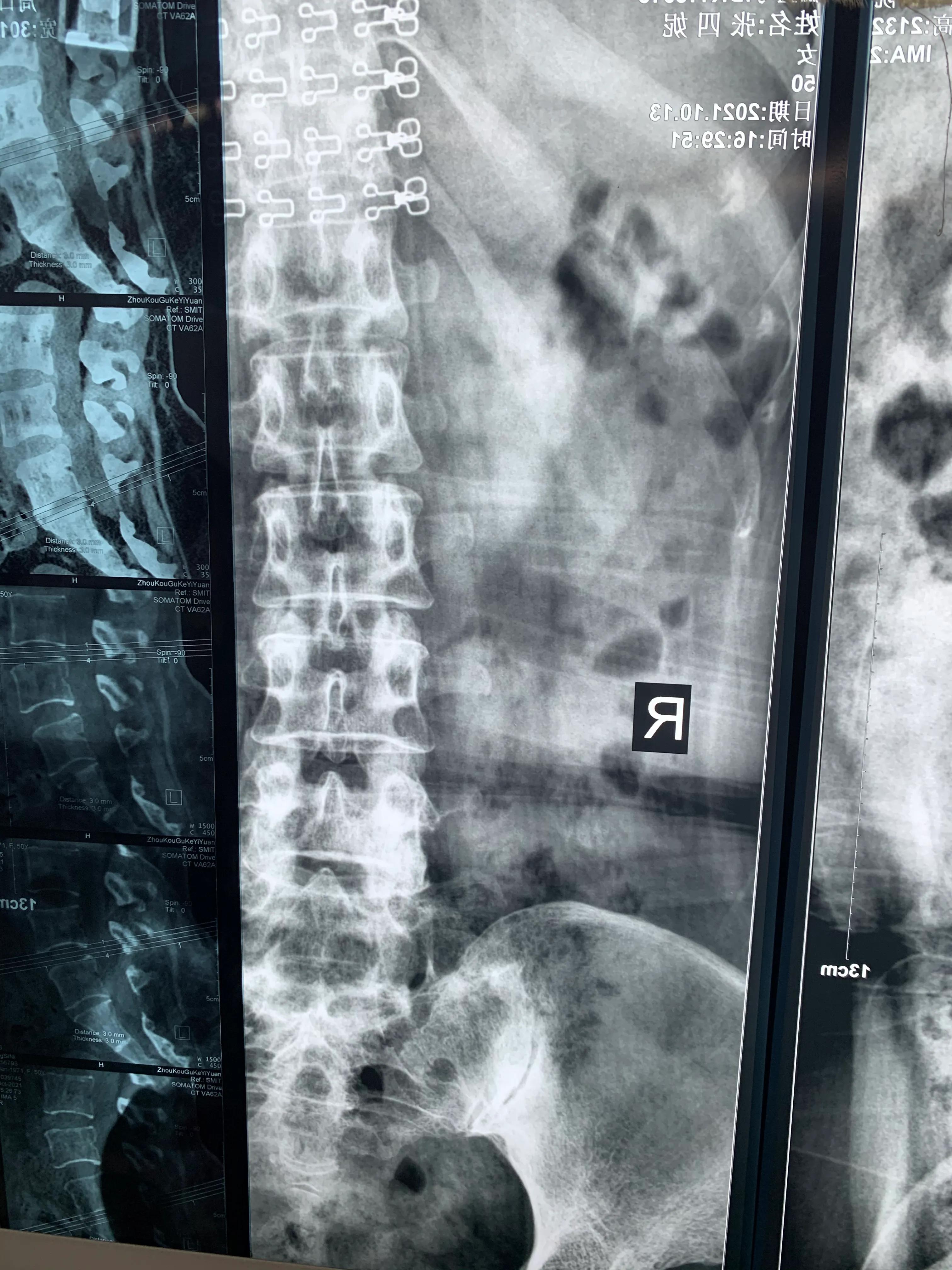 椎间孔镜术后腰痛症状多久消失,盘源性腰痛手术后易复发吗