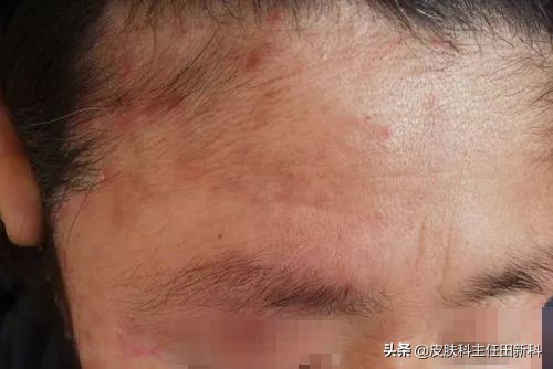 脸上成片斑是哪里出了问题,脸上痘印变成癣了怎么回事
