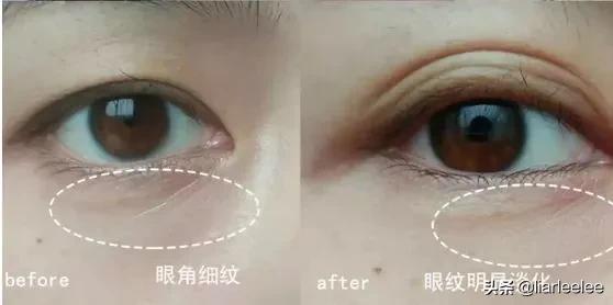 眼角皱纹最显老要注意防晒,眼角皱纹去皱最有效的方法