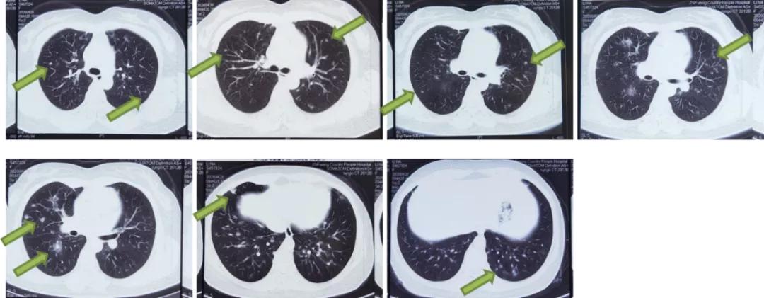 双肺多发结节，反复检查为何诊断重点成「盲区」？