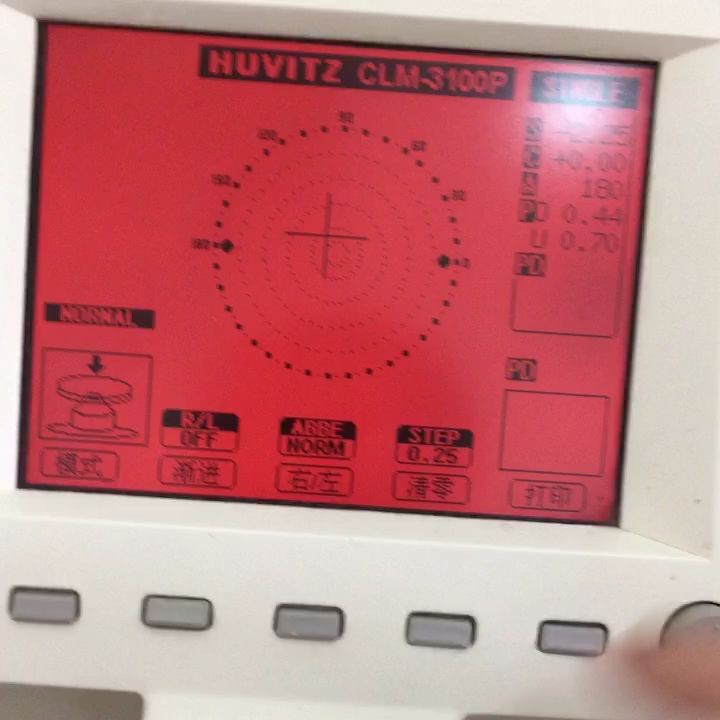 12岁一年近视度数增加200度正常吗,第一次配眼镜度数就300多