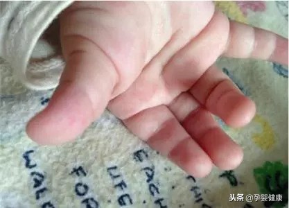 宝宝冬季冻疮怎么办,宝宝冬天身上长冻疮