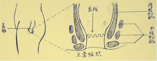 肛周脓肿和肛瘘手术多久能愈合,肛周脓肿引发肛瘘需要多久形成