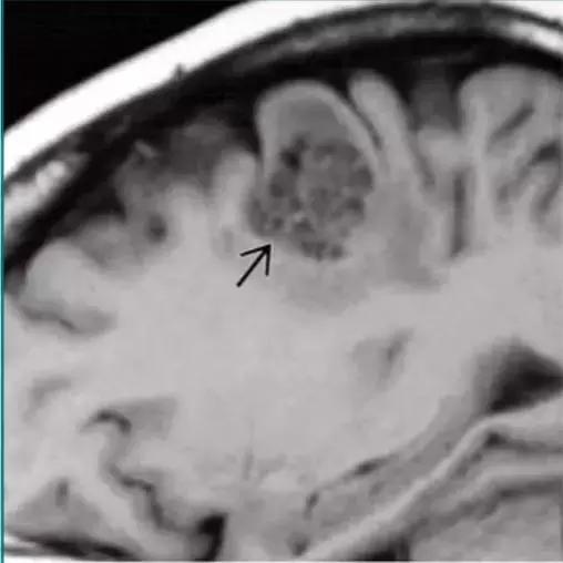 各种囊肿的症状,颅内囊肿18-19mm严重吗
