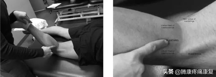 腓肠肌撕裂怎么算痊愈图文,腓肠肌撕裂怎么治疗