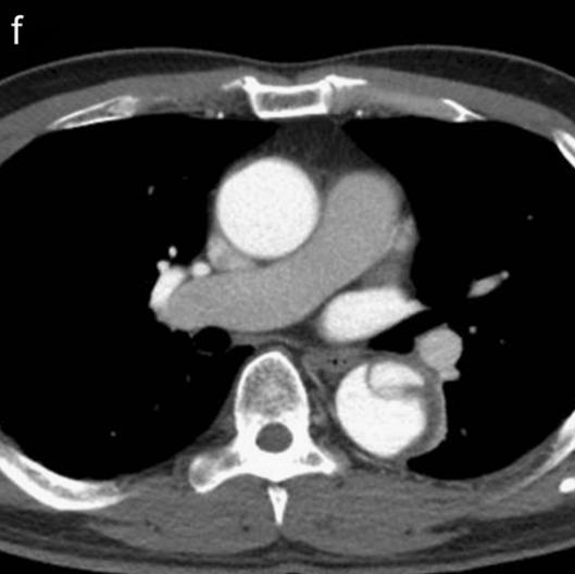 胸部Ct平扫能查出主动脉夹层吗,主动脉夹层cta影像图片解读