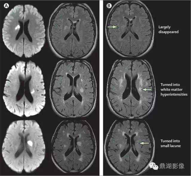 脑血管病影像诊断大全汇总,脑小血管病变影像学表现