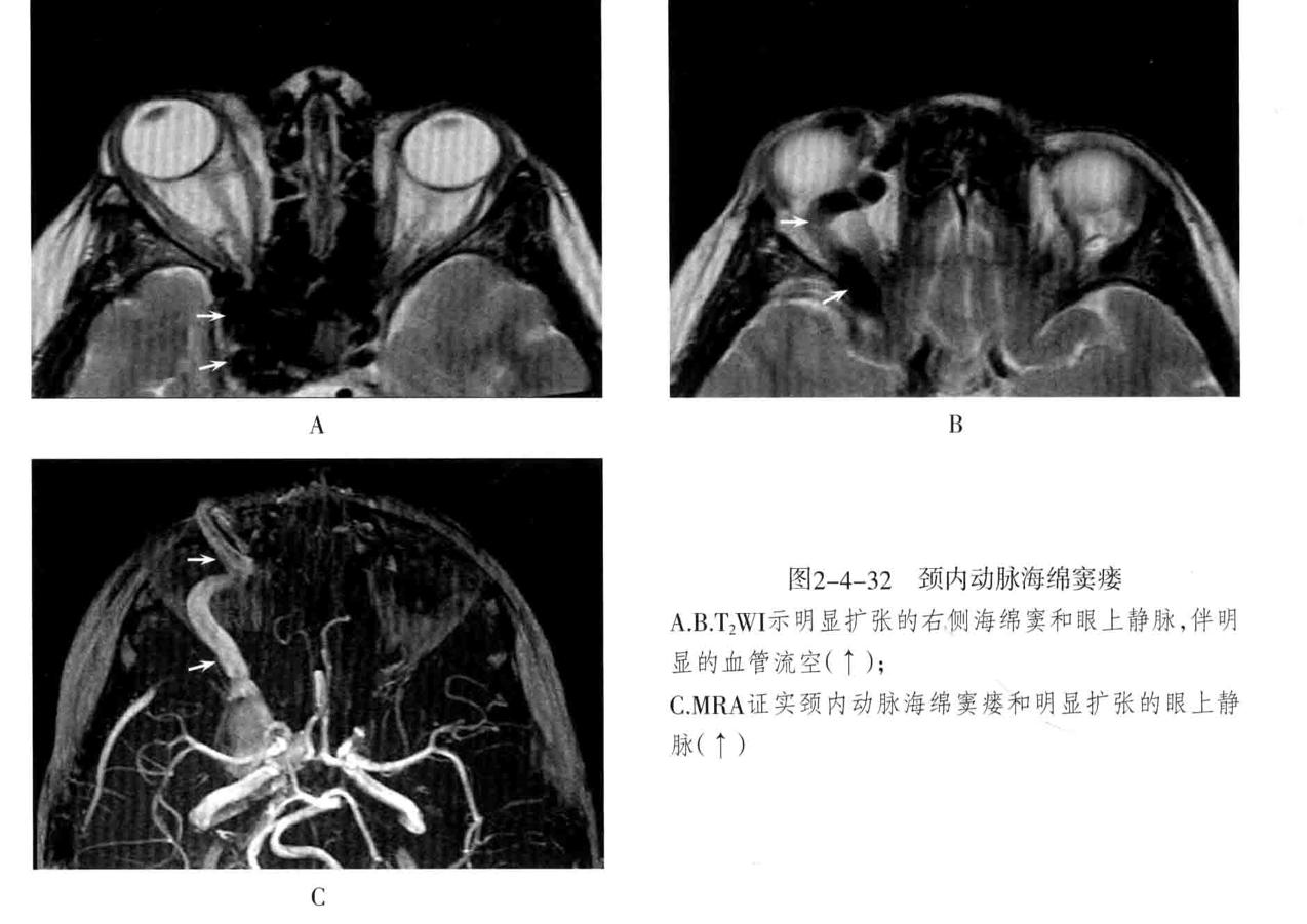 颅内血管轻度狭窄诊断标准,颅内血管先天变异影像