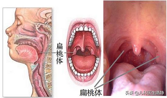 幼儿扁桃体化脓高烧不退怎么办,儿童扁桃体溃疡高热不退