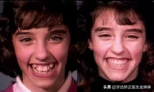 牙齿矫正拔牙牙缝多久能关上,淄博牙齿矫正一般多少钱