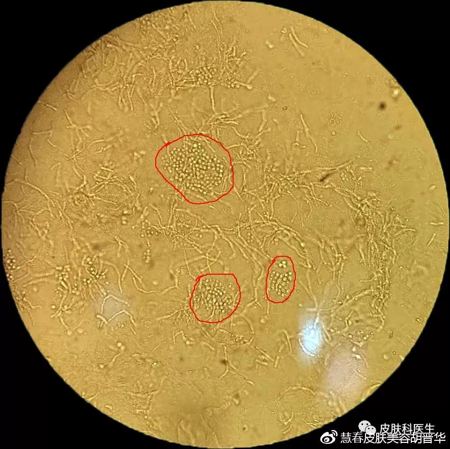 是不是皮肤癣，皮肤真菌镜检来告诉你！